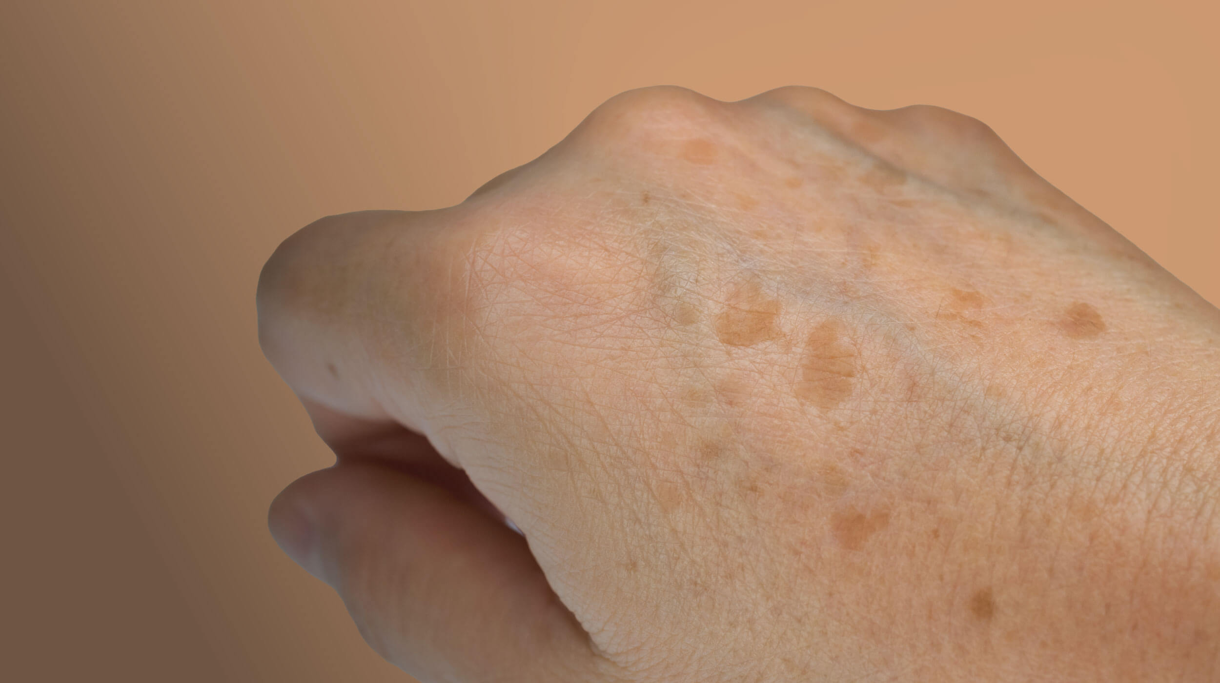 Χέρι με εμφανείς δυσχρωμίες και πανάδες, ενδείξεις φωτογήρανσης και γήρανσης της επιδερμίδας. 