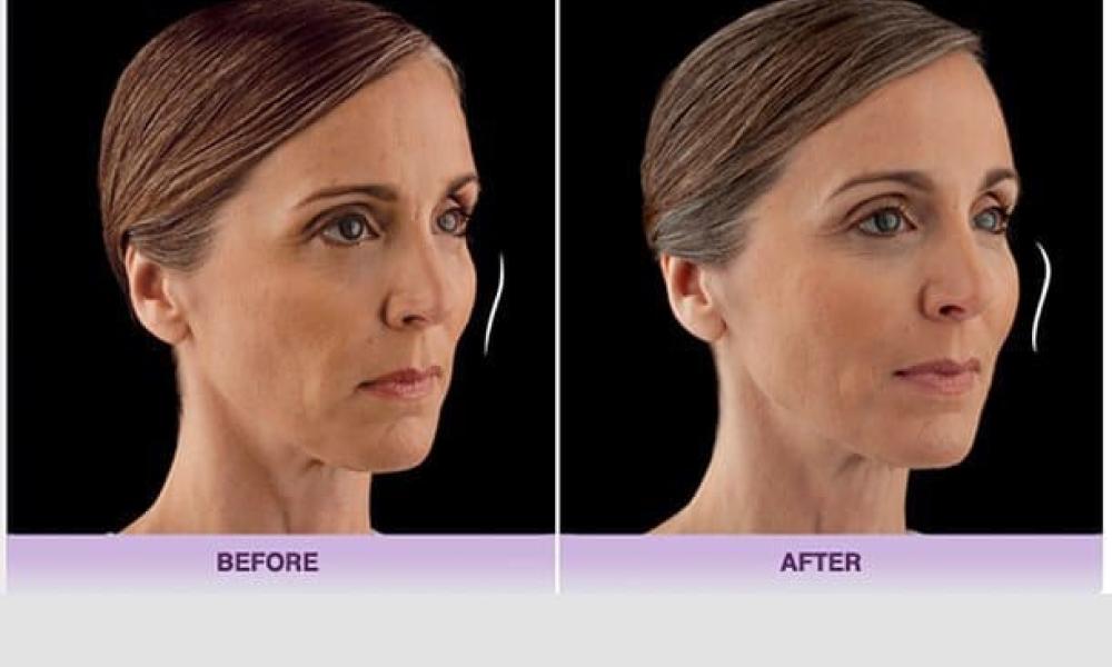 juvederm voluma before after