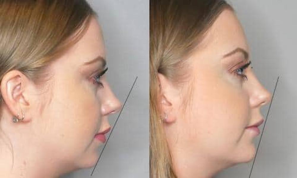 profile alignment volux chin