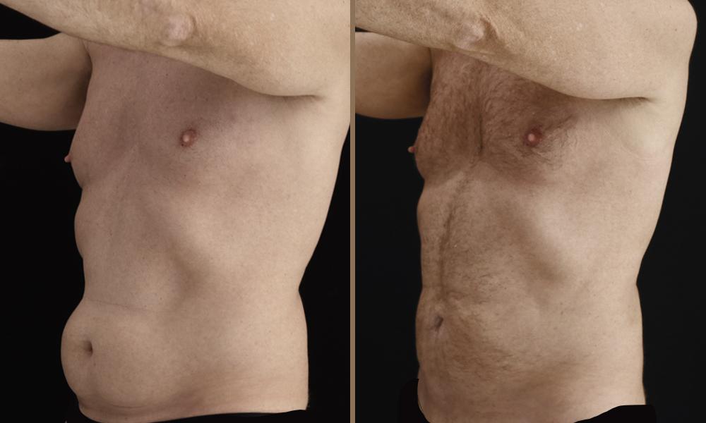 argon plasma koilia 8