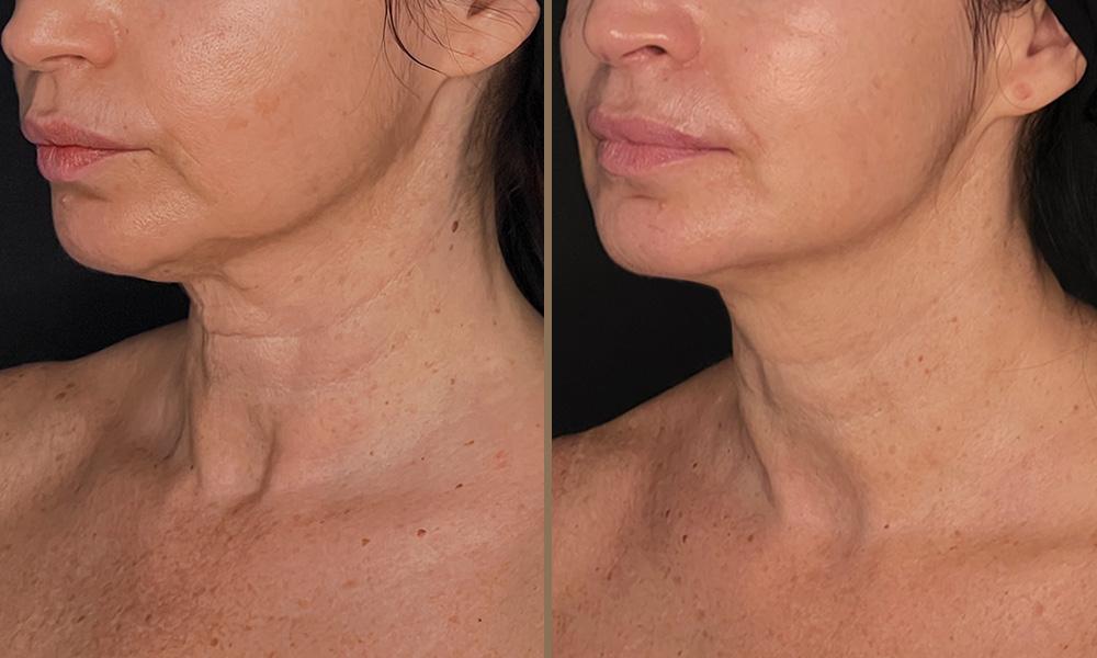 thermage logotheti argyro B