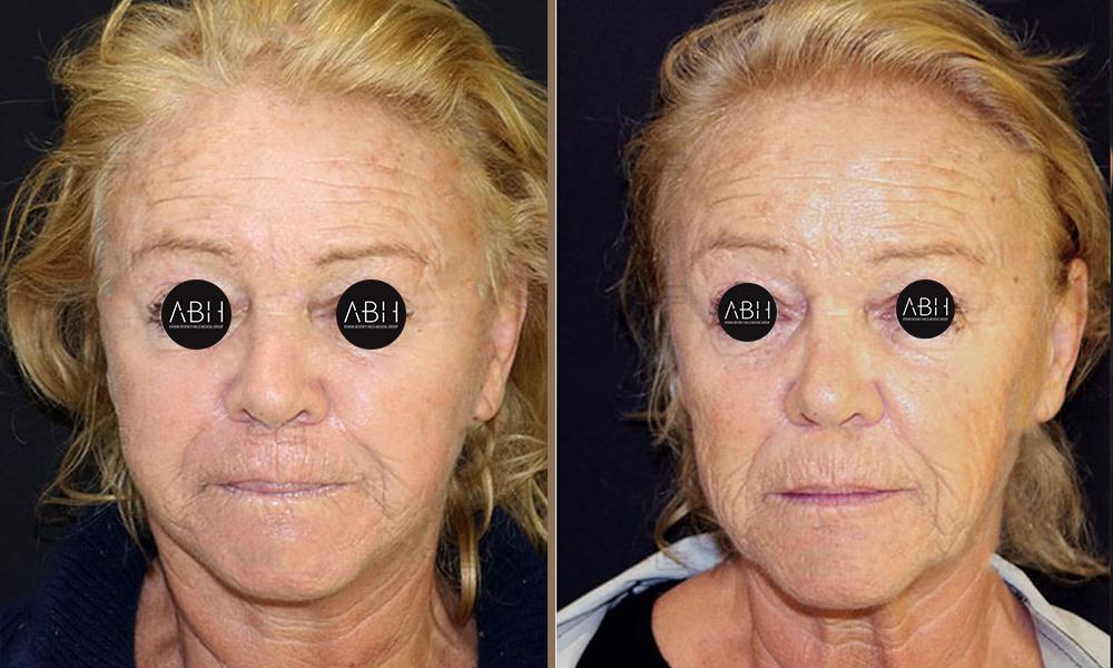 nanofat-grafting-abh-2