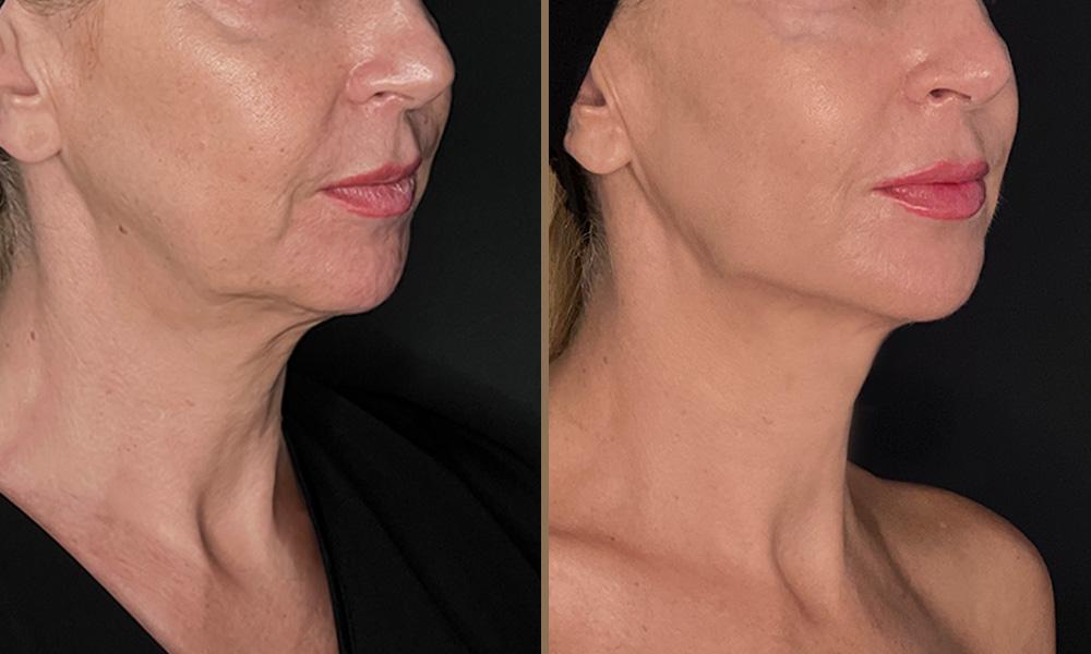 thermage-sari-kelli A