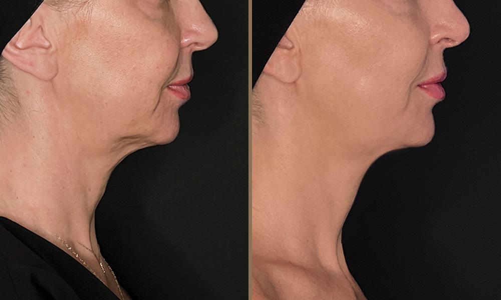 thermage-sari-kelli B