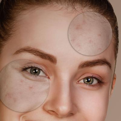 Ακμή σε πρόσωπο γυναίκας – εικόνα με σημεία ακμής και ουλών στο μέτωπο και τα μάγουλα, για ενημέρωση & αντιμετώπιση. 