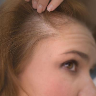 Γυναίκα με σημάδια αλωπεκίας ανασηκώνει τα μαλλιά της και εμφανίζεται αραίωση στο πλάι του τριχωτού της κεφαλής. 