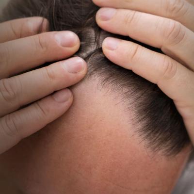 Άνδρας που αποκαλύπτει την περιοχή του μετώπου και των κροτάφων, δείχνοντας εμφανή αραίωση μαλλιών.