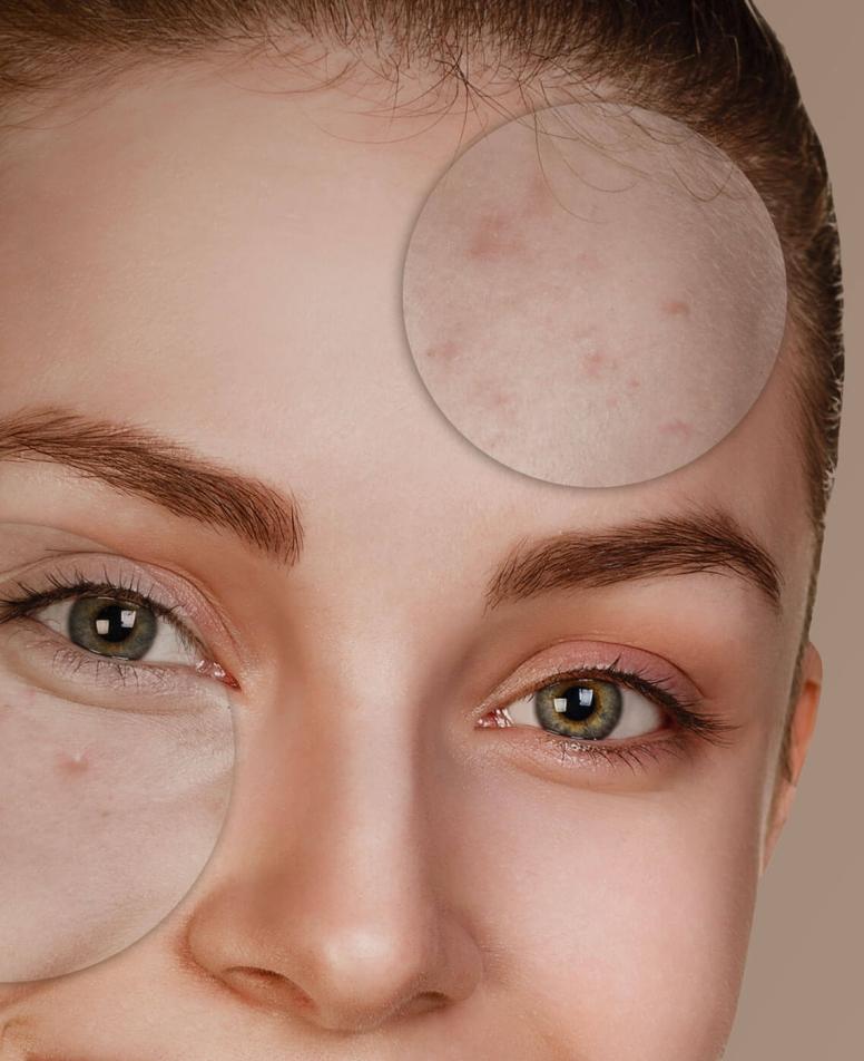 Ακμή σε πρόσωπο γυναίκας – εικόνα με σημεία ακμής και ουλών στο μέτωπο και τα μάγουλα, για ενημέρωση & αντιμετώπιση. 