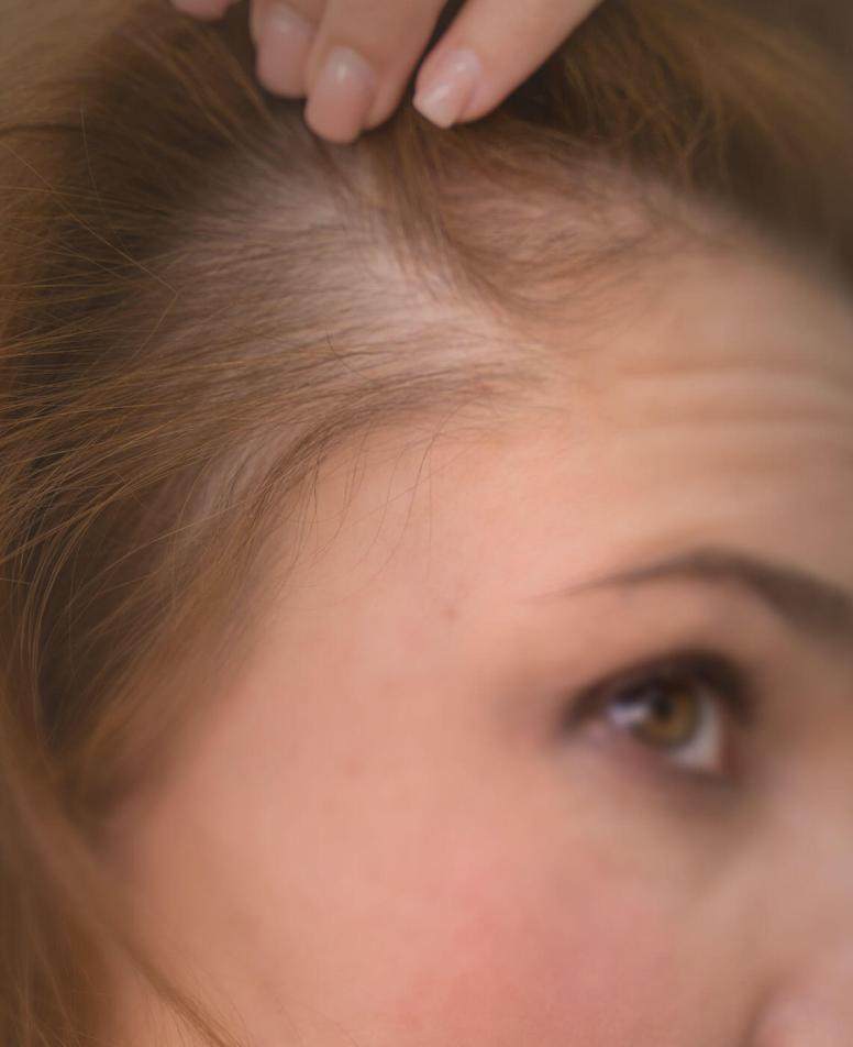 Γυναίκα με σημάδια αλωπεκίας ανασηκώνει τα μαλλιά της και εμφανίζεται αραίωση στο πλάι του τριχωτού της κεφαλής. 