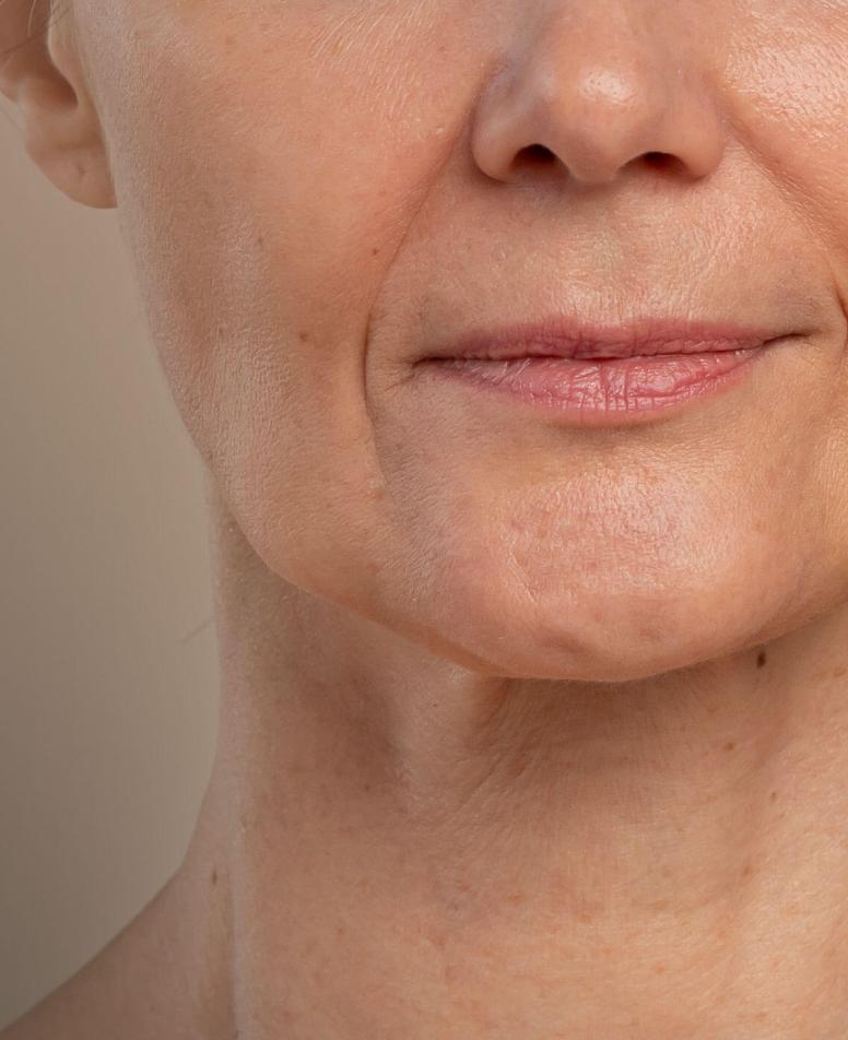 Κοντινό πλάνο του λαιμού και του προσώπου μιας γυναίκας, με εμφανείς λεπτές ρυτίδες και απώλεια ελαστικότητας.
